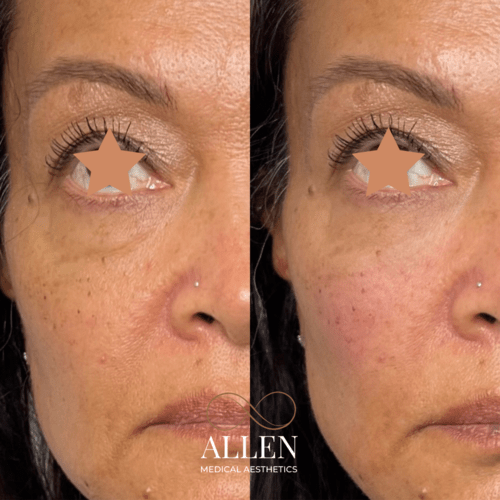 allenmedicalaesthetics_dermal-filler-tear-trough-ab-a