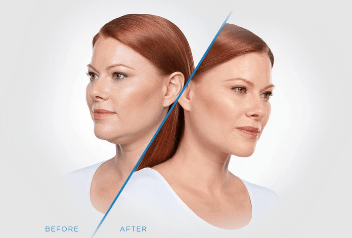allenmedicalaesthetics_kybella_ba