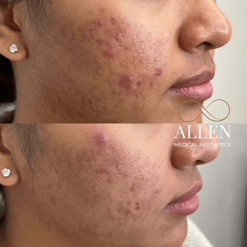 allenmedicalaesthetics_microneedling-ab-c