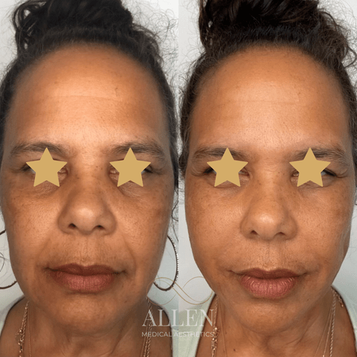 allenmedicalaesthetics_pdo-threadlifts-ab-e