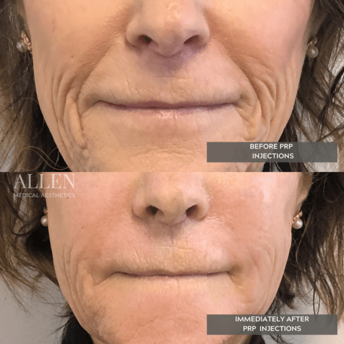 allenmedicalaesthetics_prp-procedures-ab-c