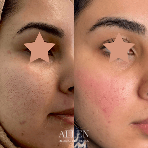 allenmedicalaesthetics_prp-procedures-ab-d