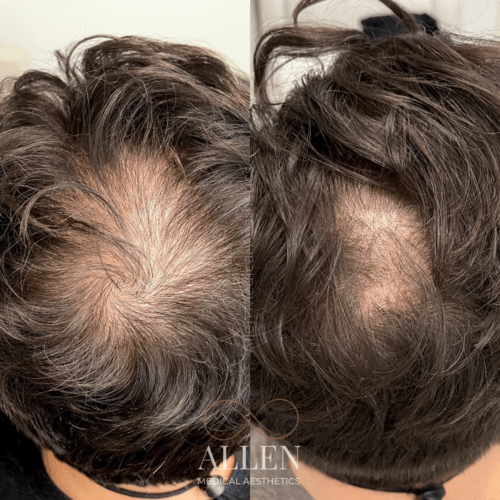 allenmedicalaesthetics_prp-procedures-ab-f
