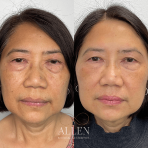 RF MICRONEEDLING WITH SYLFIRM X