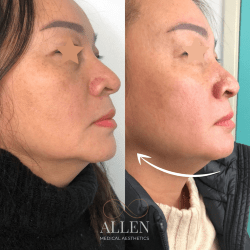 allenmedicalaesthetics_ultherapy-ab-a