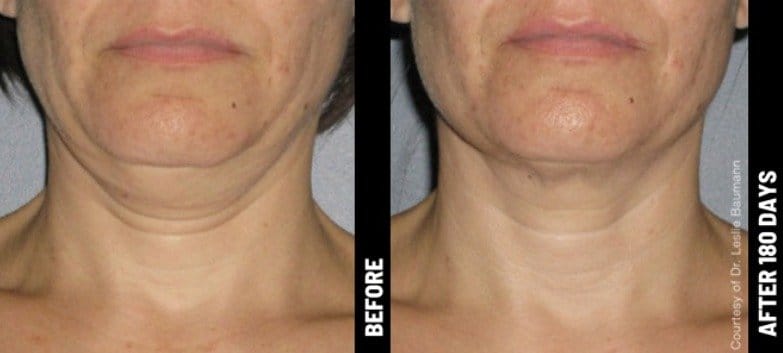 allenmedicalaesthetics_ultherapy-ba-a