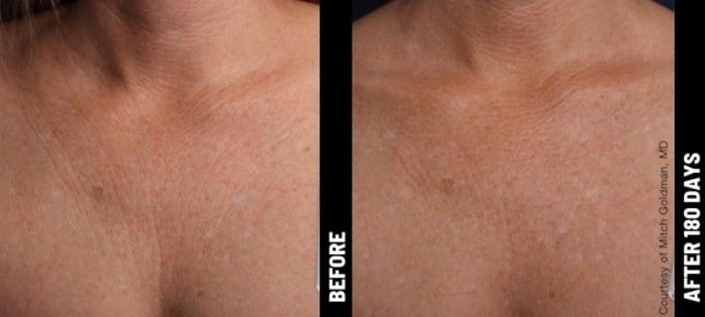 allenmedicalaesthetics_ultherepy-ba
