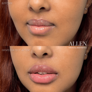 Allen Medical Aesthetics lip filler before and after