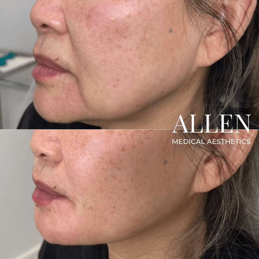 Allen Medical Aesthetics before and after photos september 2023