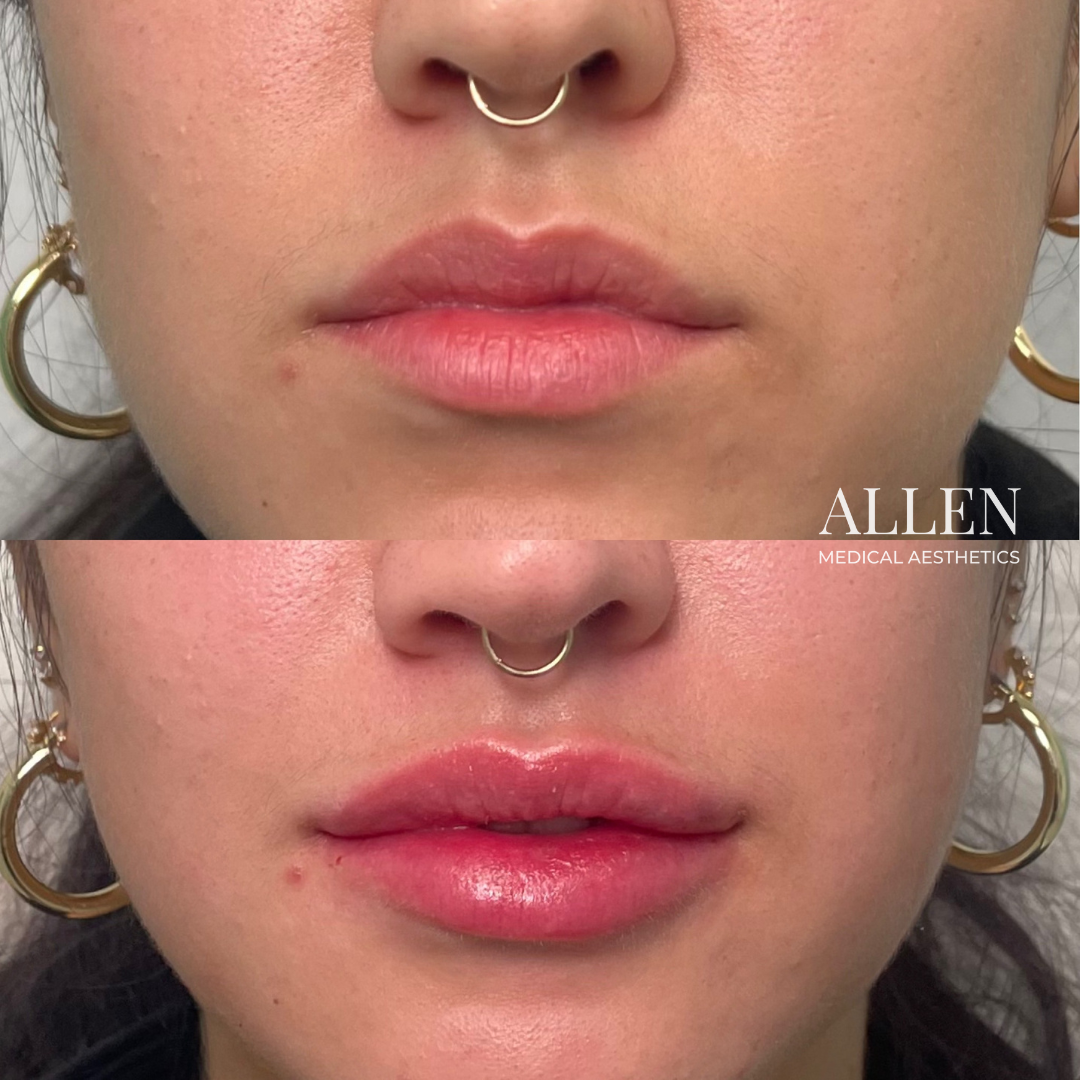 Allen Medical Aesthetics Lip Filler Photo - Before and After