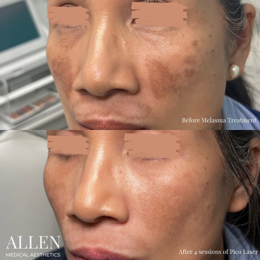 melasma treatment results