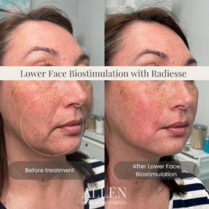 Biostimulation with hyperdilute radiesse seattle lower face