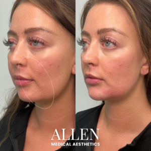 LOWER FACE BIOSTIMULATION WITH RADIESSE SEATTLE