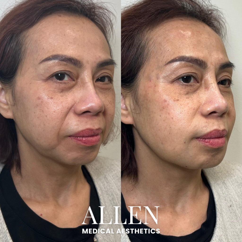 LOWER FACE BIOSTIMULATION WITH HYPERDILUTE RADIESSE SEATTLE
