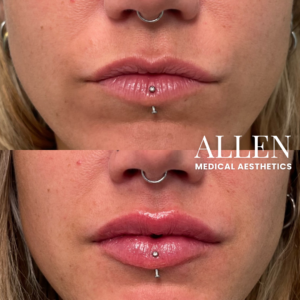 LIP FILLER SEATTLE