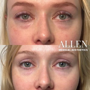 EZ GEL PRF UNDEREYES SEATTLE