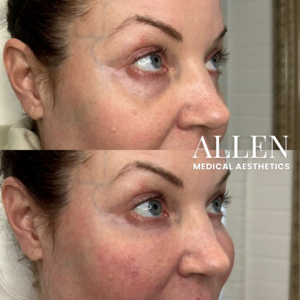 EZ GEL PRF UNDEREYES SEATTLE