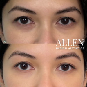 EZ GEL PRF UNDEREYES SEATTLE