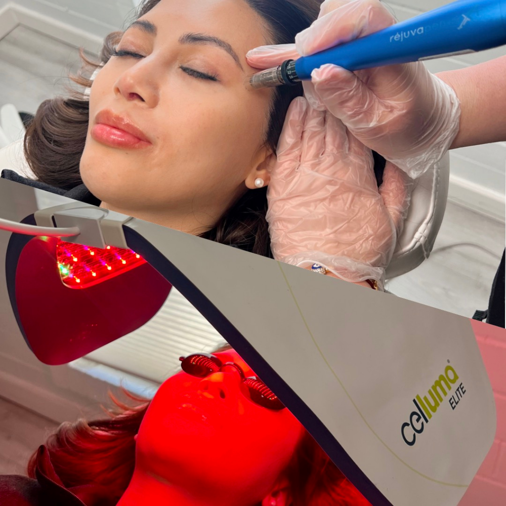 prf prp microneedling seattle