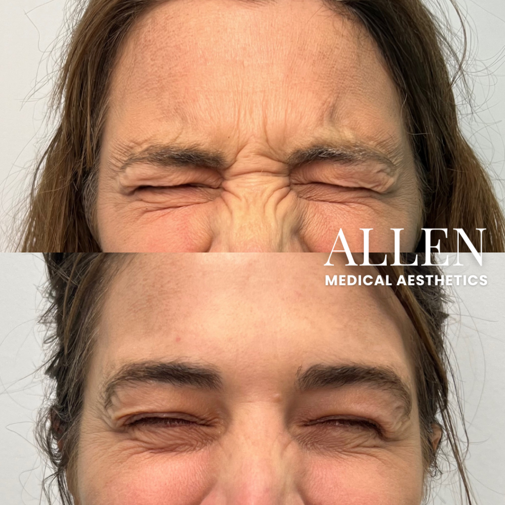 botox xeomin dysport daxxify seattle