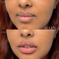 Allen Medical Aesthetics lip filler before and after