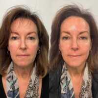 PICO Skin Rejuvenation