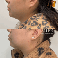 allen-medical-aesthetics-medical-kybella