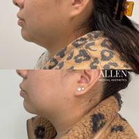 allen-medical-aesthetics-medical-kybella